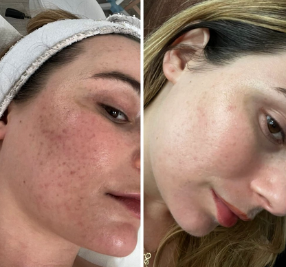 Stylo Microneedle A8™ Version [ Pack débutant ]