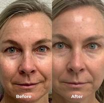 Stylo Microneedle A8™ Version [ Pack débutant ]