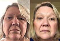 Stylo Microneedle A8™ Version [ Pack débutant ]